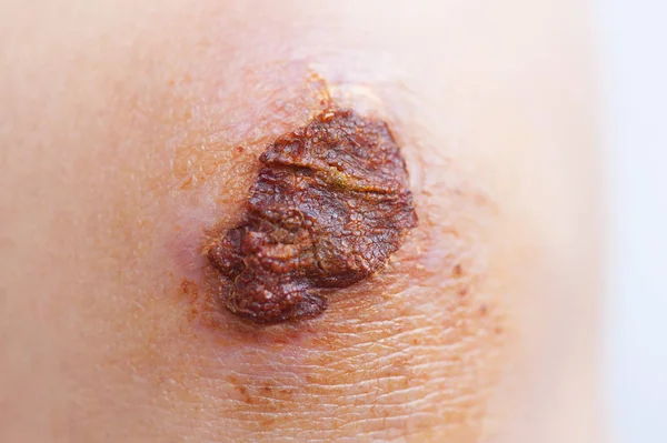 女性膝盖上的疤痕和疤痕 — 图库照片