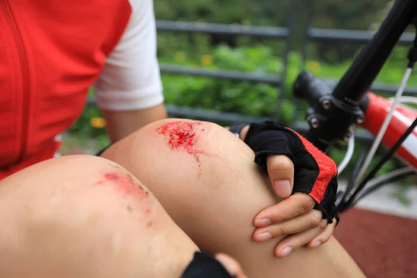 自転車の怪我 女性サイクリストはサイクリング中に転倒し 両膝を負傷 — ストック写真