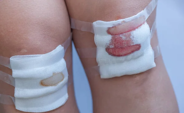 Close Scraped Human Knees Gauze — Stock Photo, Image