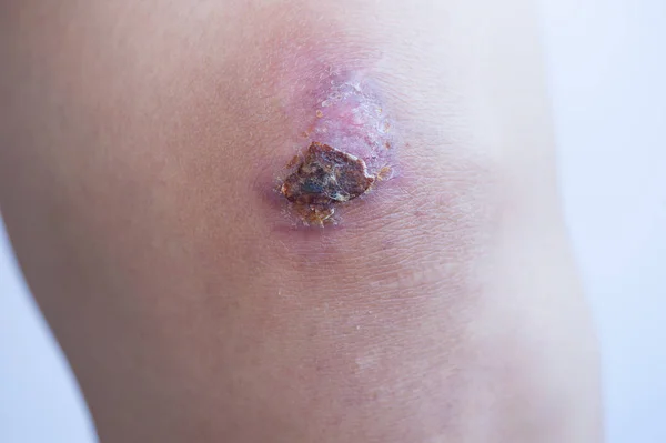 アジアの女性の膝の瘢痕とかさぶた エシャール — ストック写真