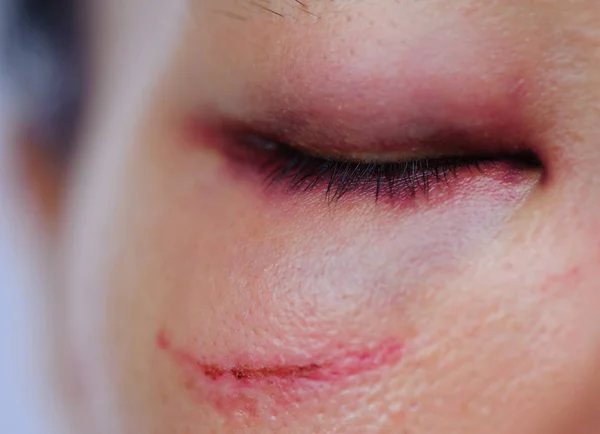 Black Bruised Woman Eye Close — Stock Photo, Image