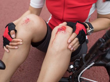Bike injuries, woman cyclist fell down while cycling,injured both knees clipart