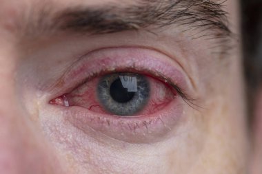Close up of a severe bloodshot eye. Blepharitis, Conjunctivitis condition clipart