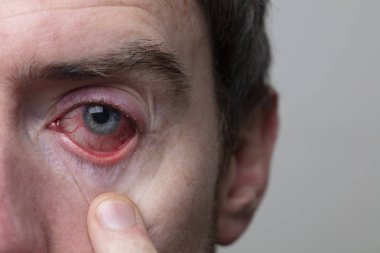 Şiddetli bir kanlanmış göz kapağı. BlePharitis, Conjunctivitis durumu