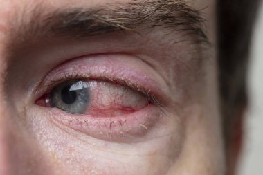 Şiddetli bir kanlanmış göz kapağı. BlePharitis, Conjunctivitis durumu