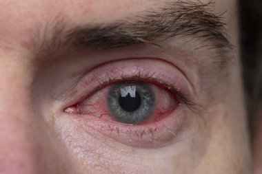 Close up of a severe bloodshot eye. Blepharitis, Conjunctivitis condition clipart