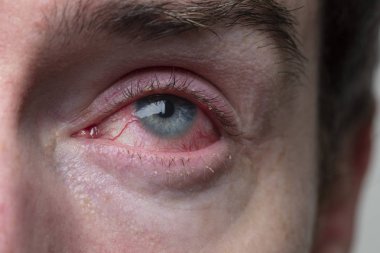 Şiddetli bir kanlanmış göz kapağı. BlePharitis, Conjunctivitis durumu