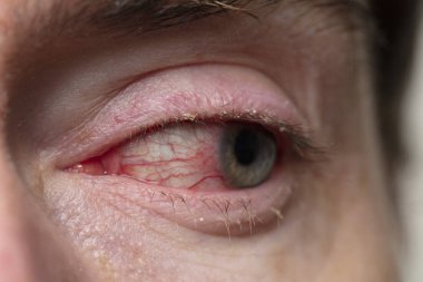 Şiddetli bir kanlanmış göz kapağı. BlePharitis, Conjunctivitis durumu