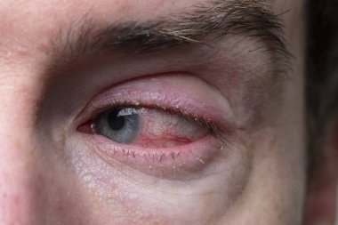 Şiddetli bir kanlanmış göz kapağı. BlePharitis, Conjunctivitis durumu