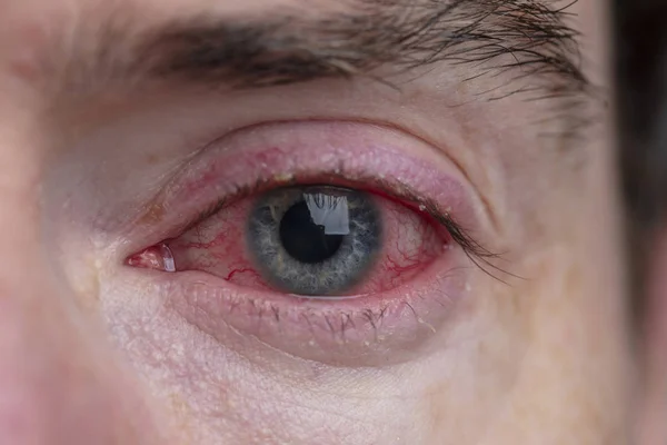 Un primer plano de un severo ojo inyectado en sangre. Blefaritis, Conjuntivitis — Foto de Stock