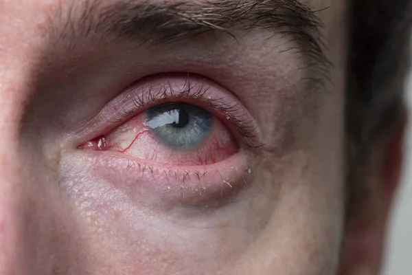 Un primer plano de un severo ojo inyectado en sangre. Blefaritis, Conjuntivitis —  Fotos de Stock