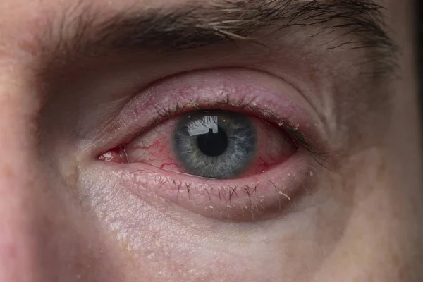 Zamykamy ostre przekrwione oko. Zapalenie błony śluzowej oka, zapalenie spojówek — Zdjęcie stockowe