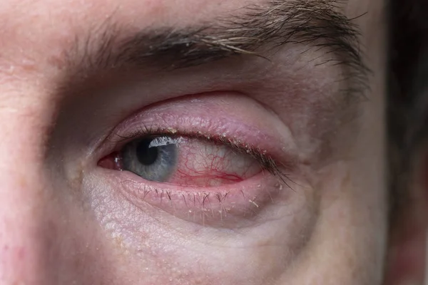 Un primer plano de un severo ojo inyectado en sangre. Blefaritis, Conjuntivitis —  Fotos de Stock