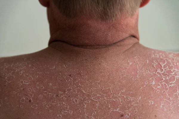Nach Sonnenbrand Blasen Rücken Erschnüffeln — Stockfoto