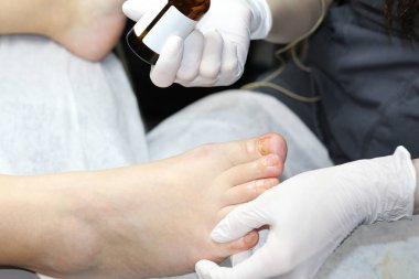 Jel cilası çıkardıktan sonra ayak tırnakları. Çirkin ayak tırnakları.