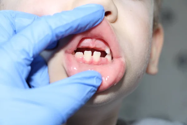 A dentist examines the baby teeth in the boy. The loss of milk teeth.