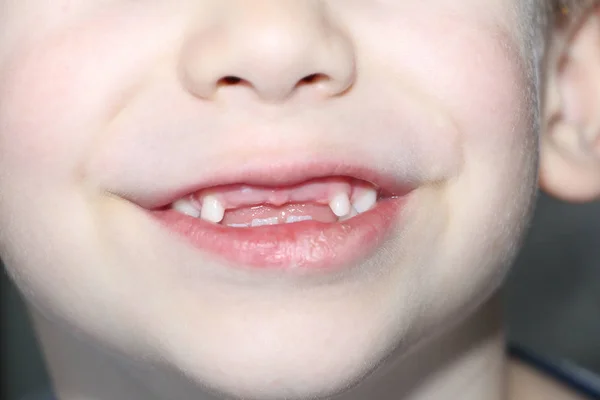 The boy smiles, his milk teeth are visible. Loss of milk teeth.