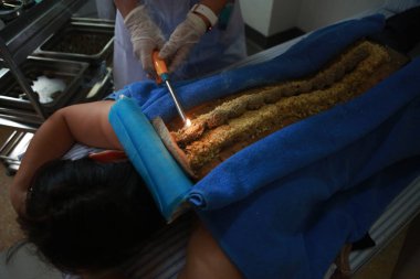 A Chinese doctor uses the ginger to apply the Governor Vessel moxibustion technique of traditional Chinese medicine (TCM) on a patient in Sanfu, the hottest days of summer, at a hospital in Nanjing city, east China's Jiangsu province, 3 August 2018 clipart