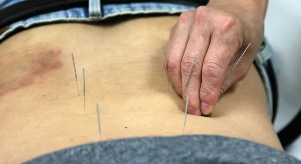 Egy Orvos Beszúrja Akupunktúrás Tűk Hagyományos Kínai Orvoslás Tcm Szervezetben — Stock Fotó