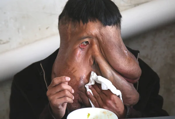 2017년 24일 후난성 용싱시 마을에서 점심을 얼굴에 15Kg의 거대한 종양을 — 스톡 사진