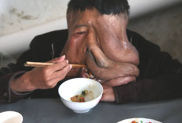 Çin Fil Adam Huang Chuncai Yüzünde 15Kg Büyük Bir Tümör — Stok fotoğraf