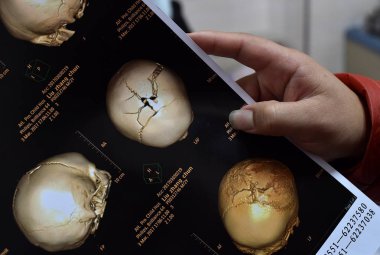 A brain CT scan shows the cracks on two-year-old boy Chinese boy Zhang Chun's head after he was attacked by his grandfather with a hammer, at a hospital in Hefei city, east China's Anhui province, 27 March 2017 clipart