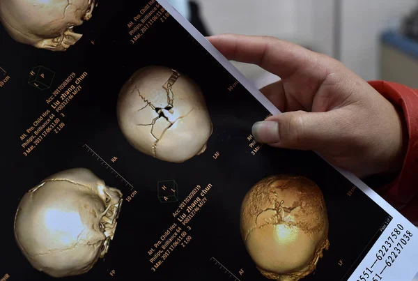 Scanner Cérébral Montre Les Fissures Sur Tête Garçon Chinois Deux — Photo