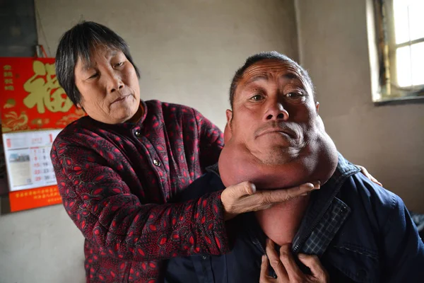 Letý Čínský Vesničan Liu Zhiho Který Utrpěl Obří Lipoma Krku — Stock fotografie