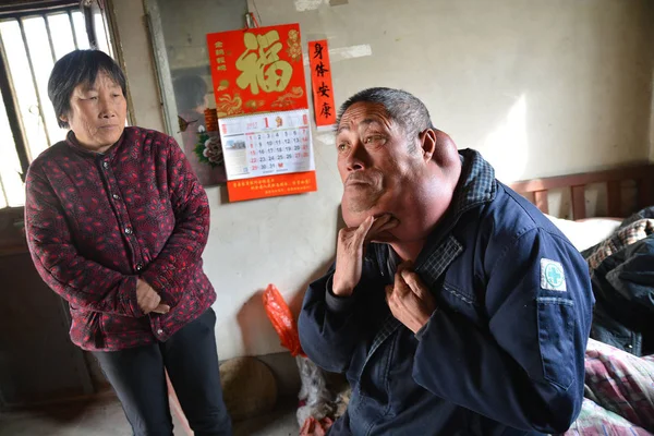 Éves Kínai Falusi Liu Zhihe Aki Szenvedett Óriás Lipoma Nyakán — Stock Fotó