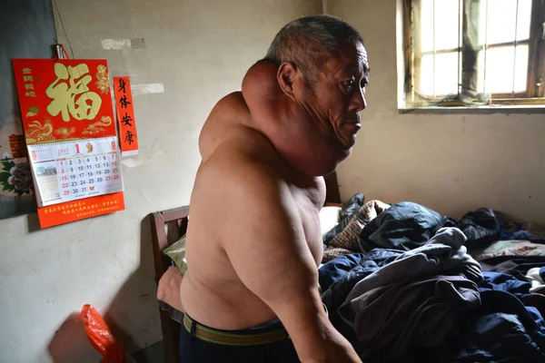 Letý Čínský Vesničan Liu Zhiho Který Utrpěl Obří Lipoma Krku — Stock fotografie