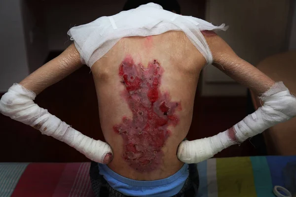 1月10日 在中国东部安徽省池州市 19岁的中国男孩梅晓 Mei Xiao 被诊断出患有遗传性皮肤病 被用医用织物包裹 以防止他的伤口在家中被感染 — 图库照片
