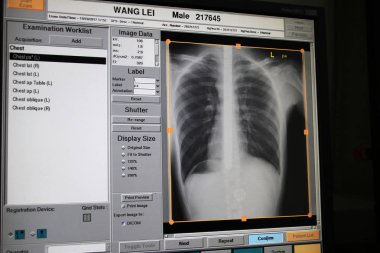 The X-ray shows that the sword goes into the esophagus of Chinese acrobat Wang Lei for almost 50 centimeters during his sword swallowing performance at a hospital in Dezhou city, east China's Shandong province, 19 October 2017 clipart