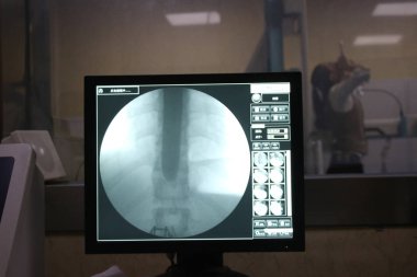 The X-ray shows that the sword goes into the esophagus of Chinese acrobat Wang Lei for almost 50 centimeters during his sword swallowing performance at a hospital in Dezhou city, east China's Shandong province, 19 October 2017 clipart