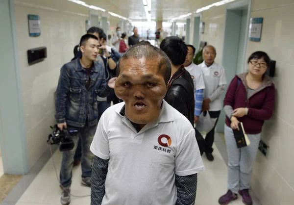 Čínský Villager Xia Yuanhai Centrum Které Cizincově Zdeformovaný Obličej Vyobrazen — Stock fotografie