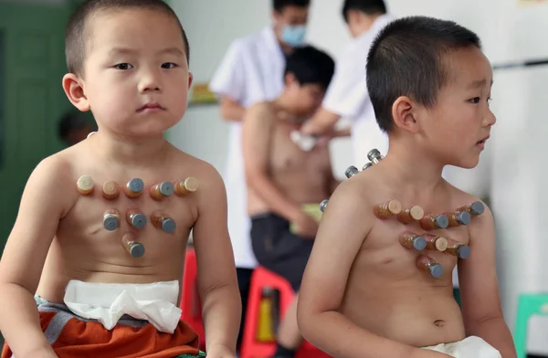 File Kinesiska Barn Får Koppning Terapi Traditionell Kinesisk Medicin Tcm — Stockfoto