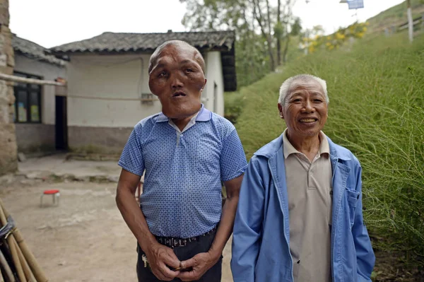 Čínský Venkovský Vesničan Xia Yuanhai Který Znetvořené Tváře Cizí Tváří — Stock fotografie