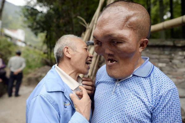 Čínský Vesničan Xia Yuanhai Který Znetvořené Tváře Svým Starším Bratrem — Stock fotografie