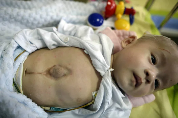 Neugeborenes Baby Einem Der Herzvorwölbung Leidet Vor Einer Operation Kinderkrankenhaus — Stockfoto