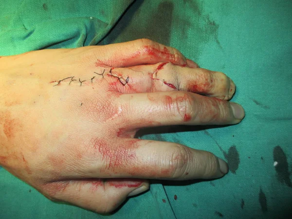 Новий Палець Другий Верх Ліворуч Від Юаня Зображений Після Операції — стокове фото