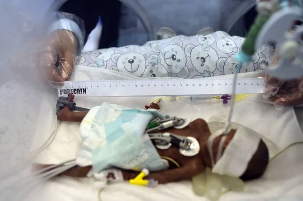 Chinese Nurse Measures China Tiniest Premature Baby Nicknamed Chopstick Baby — Stock Photo, Image