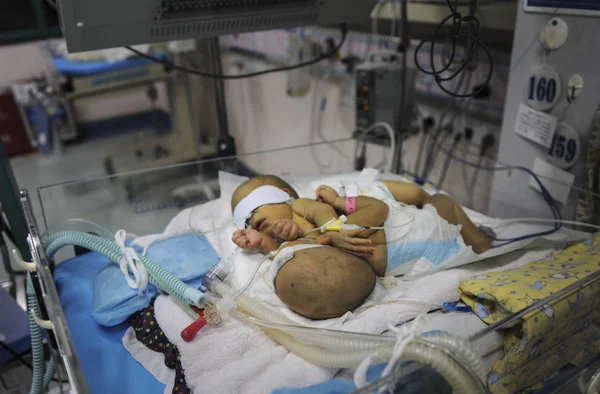 Novorozence Siamská Dvojčata Obdrží Lékařskou Péči Jip Dětské Nemocnici Městě — Stock fotografie