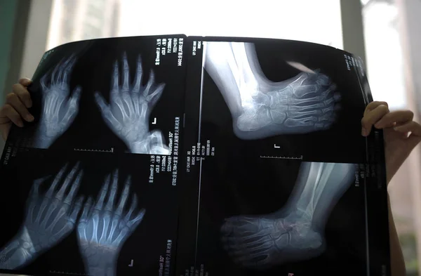 Sjuksköterska Visar Röntgenbild Händer Och Fötter Årig Flicka Tong Xiaoyu — Stockfoto