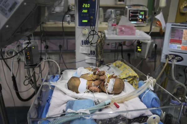 Pair Newborn Siamese Twins Receives Medical Treatment Icu Hunan Childrens — Stock Photo, Image