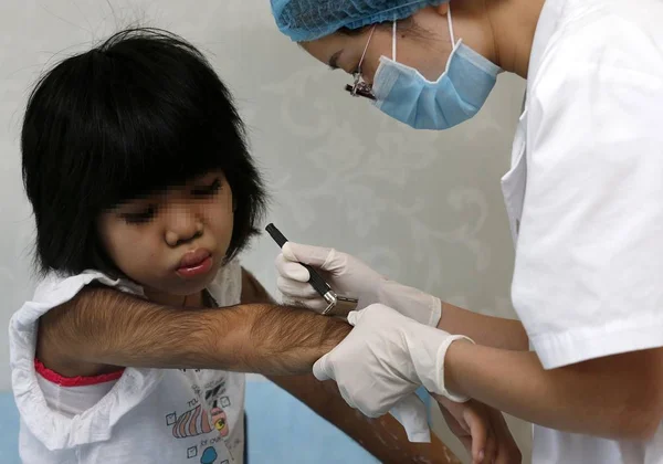 Médecin Enlève Les Cheveux Denses Sur Les Bras Une Jeune — Photo