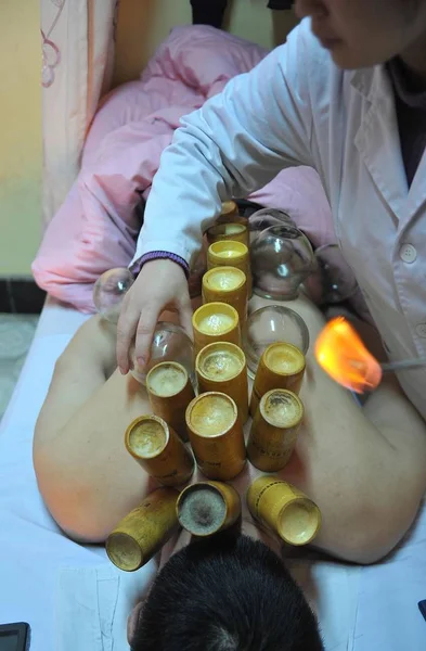 File Doctor Seen Using Cupping Patient Chengdu City Southwest Chinas — стоковое фото