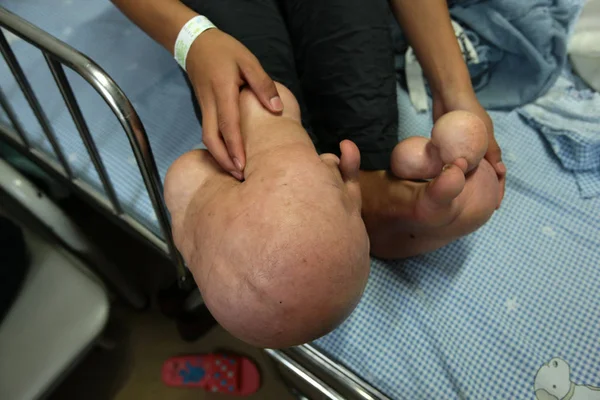 Chinese Boy Xiao Men Shows His Big Feet Sickbed Childrens — Stock Photo, Image