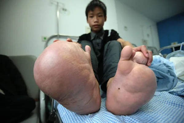 Chinese Boy Xiao Men Shows His Big Feet Sickbed Childrens — Stock Photo, Image