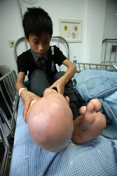 Chinese Boy Xiao Men Shows His Big Feet Sickbed Childrens — Stock Photo, Image