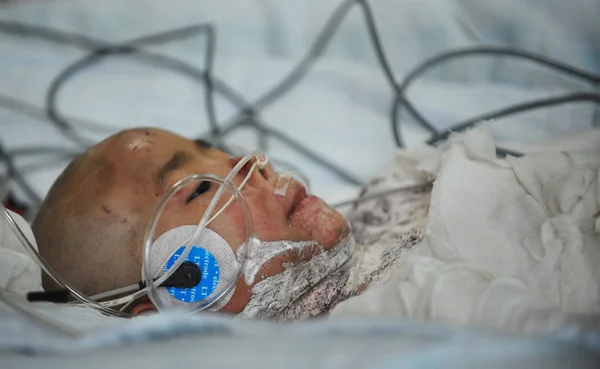 Bambina Sette Anni Gravemente Bruciata Lin Qiurong Stata Vista Ospedale — Foto Stock
