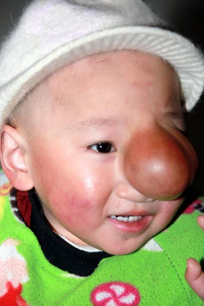 Qin Yuhang Who Suffered Facial Tumour Covers His Left Eye — Stock Photo, Image